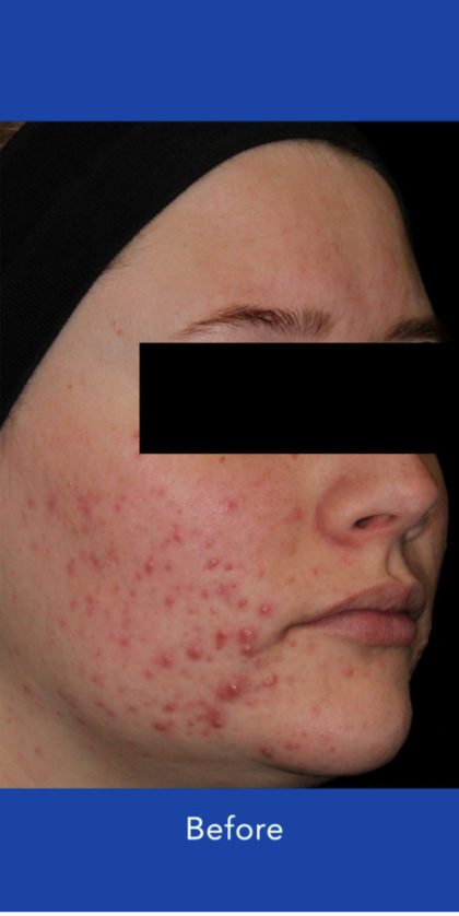 AviClear Before & After Patient #1672